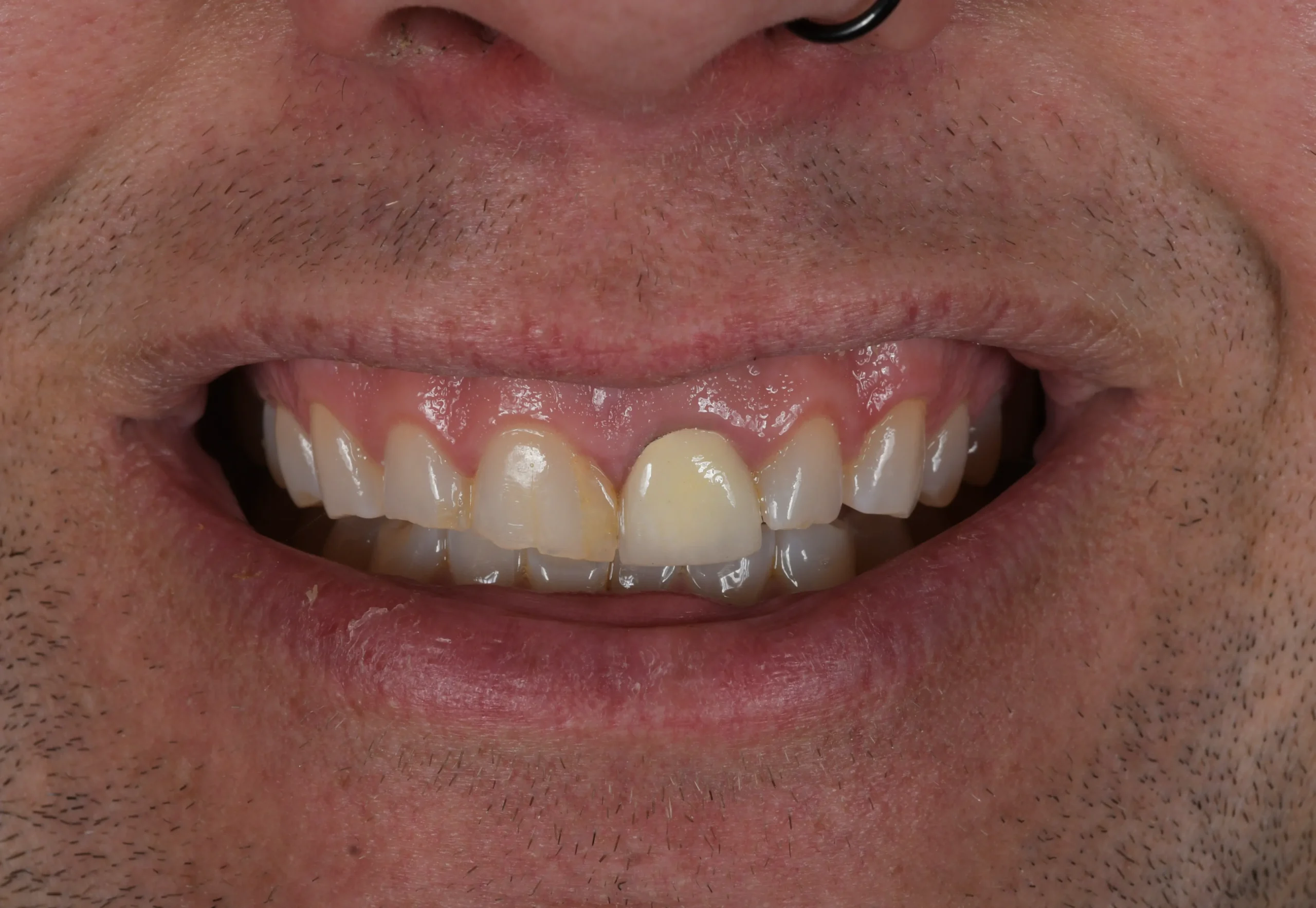 Hollywood Smile Makeover — Before